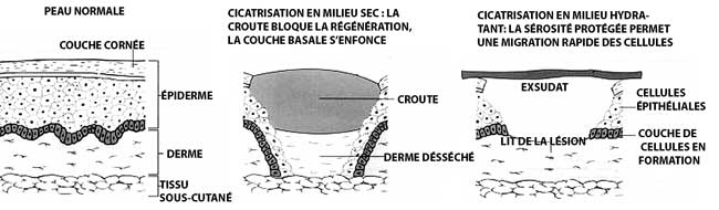 cicatrisation-milieu-humide