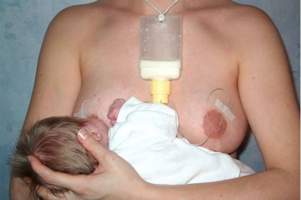 DAL, dispositif d'aide à la lactation : méta-analyse, mode d'emploi, vécu des mères