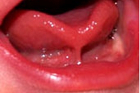 AA 95 : Freins de langue, freins de lèvre : des freins à l'allaitement