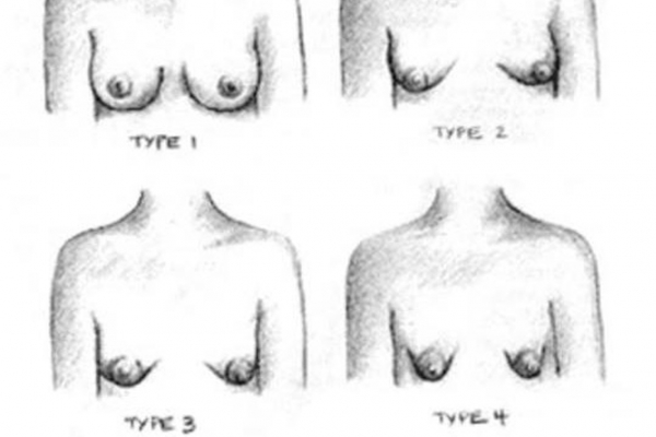 Hypoplasie mammaire