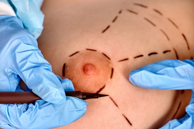 AA 57 : Allaitement et chirurgie mammaire